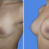mamoplastia de aumento